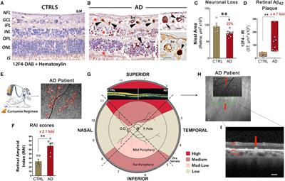 Optical Coherence Tomography in Alzheimer’s Disease and Other Neurodegenerative Diseases